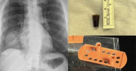 Médicos retiram brinquedo preso no pulmão há 51 anos